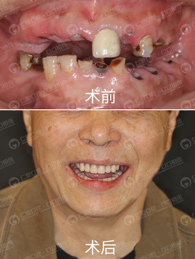 武漢仁愛口腔怎么樣,種植牙醫生及隱形矯正案例