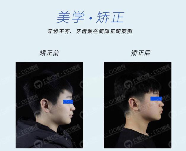 武漢仁愛(ài)口腔牙齒矯正技術(shù)好不好?