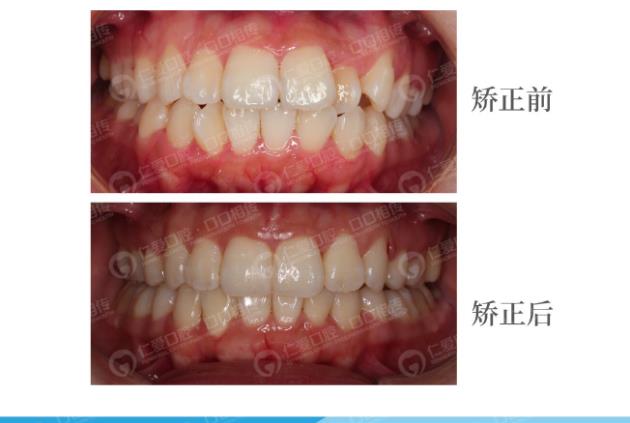 武漢仁愛口腔怎么樣,種植牙醫生及隱形矯正案例