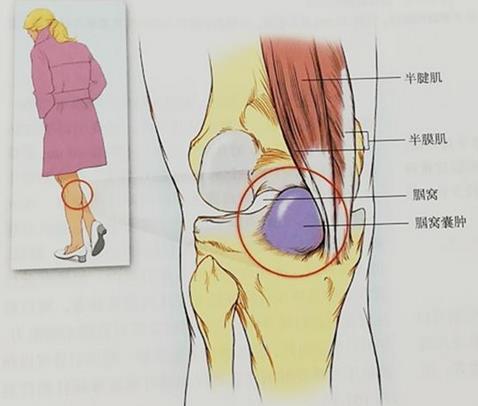 小腿吸脂為何是難點?廣州高尚形體雕塑來解疑