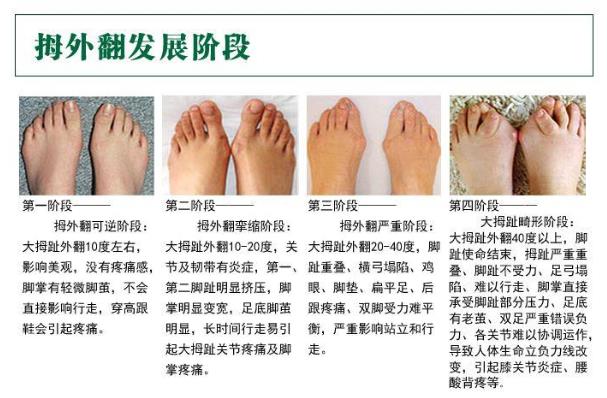 上海健橋拇外翻王慶成:拇外翻不治療會(huì)越來越嚴(yán)重嗎