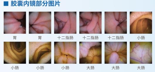呼和浩特市東大肛腸醫院 胃里為什么會長息肉?日常如何預防胃息肉