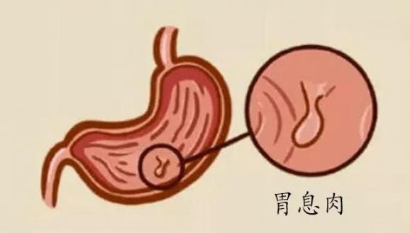 呼和浩特市東大肛腸醫院 胃里為什么會長息肉?日常如何預防胃息肉
