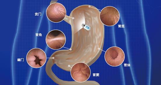 呼和浩特市東大肛腸醫院 胃里為什么會長息肉?日常如何預防胃息肉