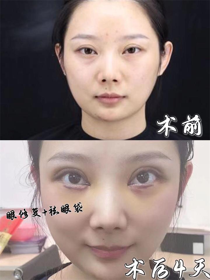 雙眼皮修復_北京哪家醫院修復好?