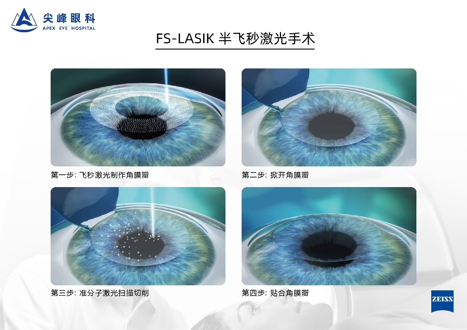 鄭州尖峰眼科醫院:近視參軍適合做哪種近視手術?