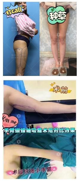 泉州海峽王振榮 年度最具影響力名醫大咖榜自體脂肪名醫