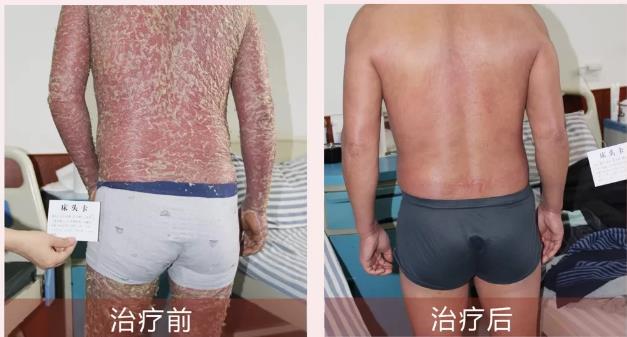 許光生:銀屑病會危及生命嗎?