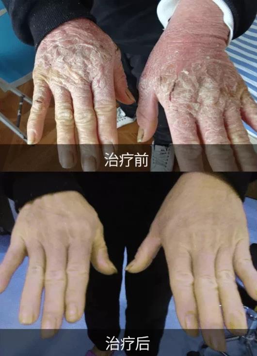 許光生:銀屑病會危及生命嗎?