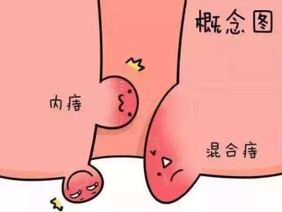 痔瘡長什么樣子的?痔瘡的早期癥狀,痔瘡圖片真人圖
