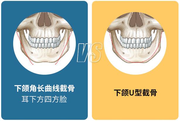 聯(lián)合麗格第一醫(yī)院何照華教授:下頜角手術(shù)選擇什么術(shù)式比較好? 666.jpg