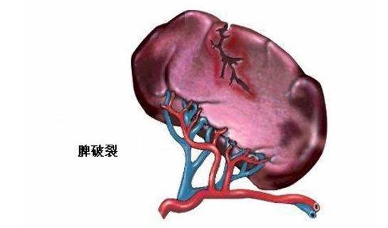 外賣小哥脾臟被摘除 導致脾破裂的原因
