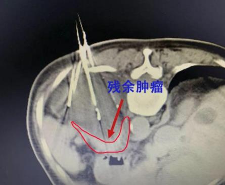 廣州復(fù)大腫瘤醫(yī)院評價好嗎 診療服務(wù)評價有保障