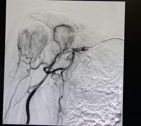廣州復大腫瘤醫院評價介入治療緩解癌痛