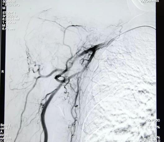 廣州復大腫瘤醫院評價介入治療緩解癌痛