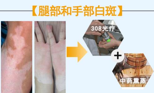 華研白癜風醫(yī)院的308激光治療效果怎么樣?前端技術,值得相信