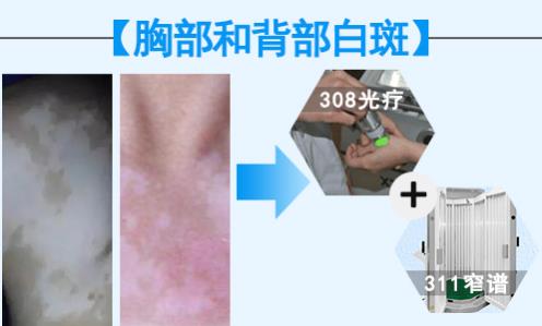 華研白癜風醫(yī)院的308激光治療效果怎么樣?前端技術,值得相信