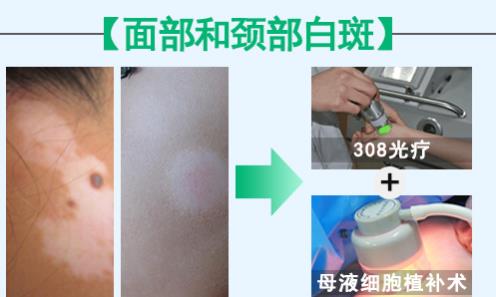 華研白癜風醫(yī)院的308激光治療效果怎么樣?前端技術,值得相信