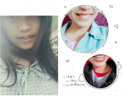 岳陽牙齒矯正會后悔嗎?分享他們的牙齒矯正經歷!