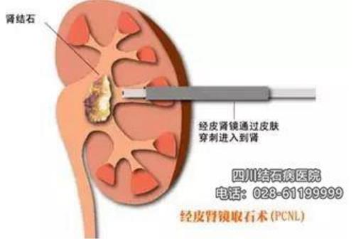 四川結石病醫院服務怎么樣 專業贏在優質服務