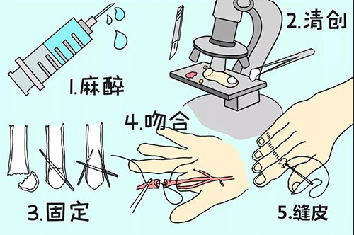 手指斷了怎么辦?濟(jì)南顯微外科醫(yī)院讓斷指失而復(fù)得! 11-12-1-500.jpg