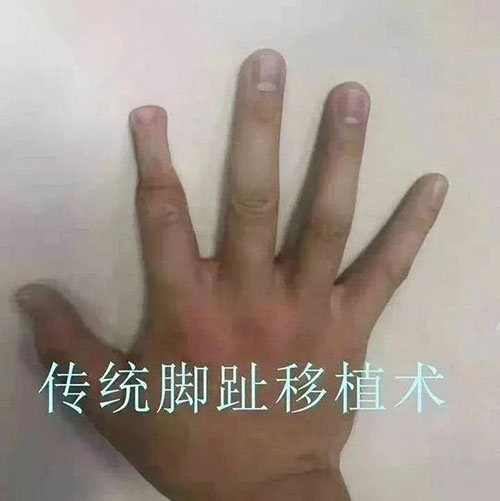 手指斷了怎么辦?濟(jì)南顯微外科醫(yī)院讓斷指失而復(fù)得! 11-3-3-500.jpg