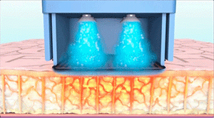 【武漢藝星整形醫院】一篇文章讓你讀懂抗衰神器“熱瑪吉”! 10.gif
