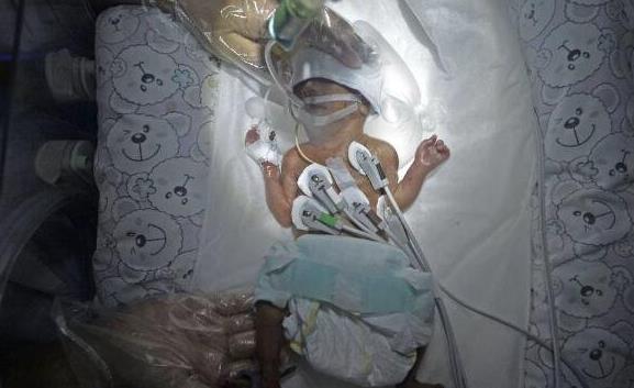存活下來世界最小早產兒3.jpg