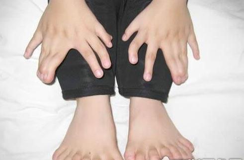 世界上手指腳趾最多的人 印度男孩34根破紀錄 手14腳20