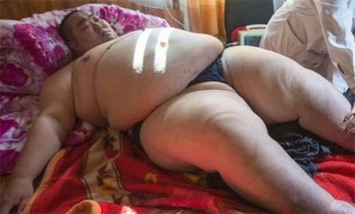 中國最胖的人 男子結扎后致體重達520斤