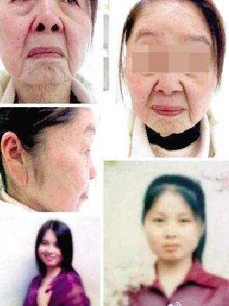 85年少婦分娩后變老太,獲得性面部皮膚衰老癥怪病無(wú)藥可醫(yī),早婚早育生第二胎
