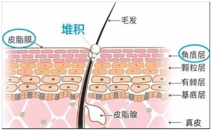 北京伊美爾幸福醫(yī)院:閉口粉刺會(huì)自己慢慢消失嗎?