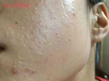 北京伊美爾幸福醫(yī)院:閉口粉刺會(huì)自己慢慢消失嗎?