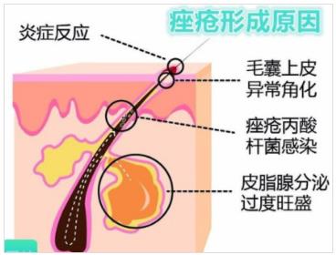 北京伊美爾幸福醫(yī)院:閉口粉刺會(huì)自己慢慢消失嗎?
