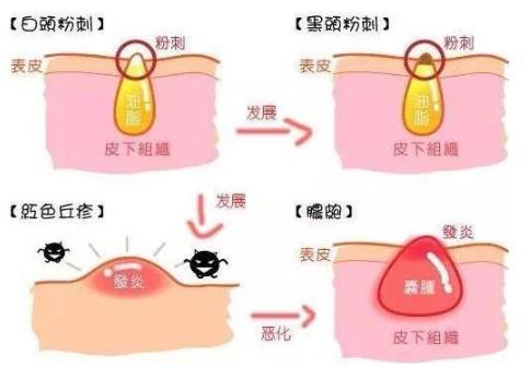 北京伊美爾幸福醫(yī)院:閉口粉刺會(huì)自己慢慢消失嗎?