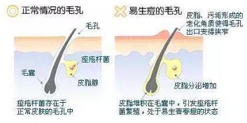 田永成醫美教你如何有效祛痘