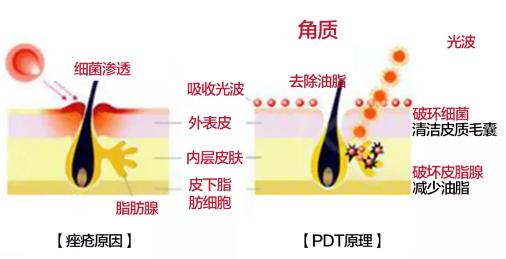 田永成醫美教你如何有效祛痘