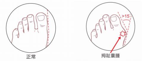 干預孩子足部拇外翻問題,可科學定制矯正鞋墊