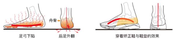 干預嚴重扁平足,科學穿著矯正鞋進行