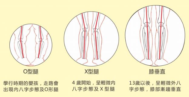 想要孩子擁有筆直長腿,家長應及時給孩子定制矯正鞋干預