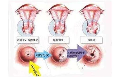 宮頸活檢費用是多少 宮頸活檢的注意事項