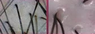 你知道頭皮的真實狀況嗎?青逸植發告訴你:發質不好是因為