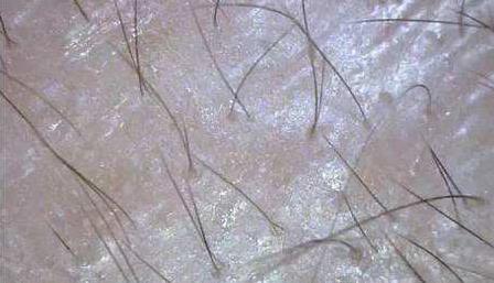 毛囊檢測(cè)有必要嗎?廣州青逸植發(fā)為你解讀,植發(fā)效果全靠它!