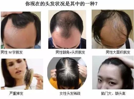 What?脫發更長壽?一招讓你既長壽又有顏!