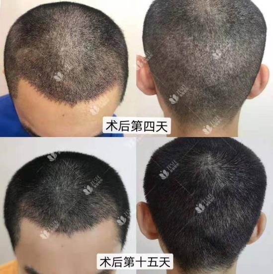 What?脫發更長壽?一招讓你既長壽又有顏!