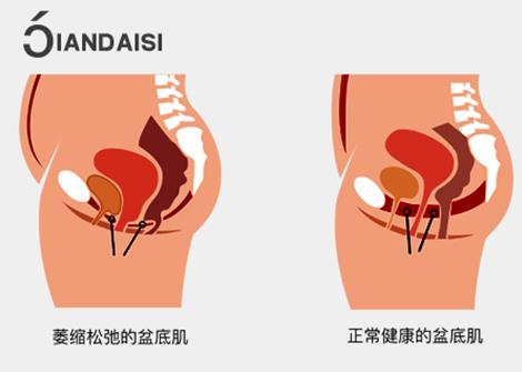 縮陰產品可以改善漏尿嗎?療效怎么樣誰用誰知道