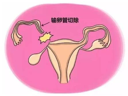 宮外孕是怎么引起的?如何有效預防宮外孕