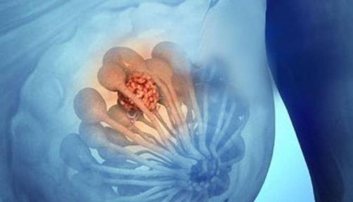乳腺小結節的危害是什么?乳腺小結節不能吃什么