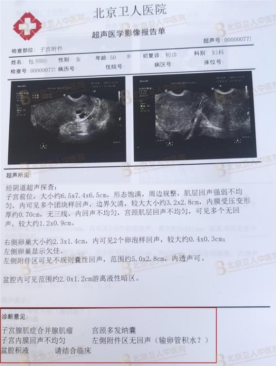 子宮腺肌癥能保住子宮嗎?50歲包大姐終于打贏這場長達20年的“子宮保衛戰”!