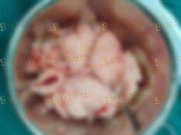 子宮腺肌癥能保住子宮嗎?50歲包大姐終于打贏這場長達20年的“子宮保衛戰”!